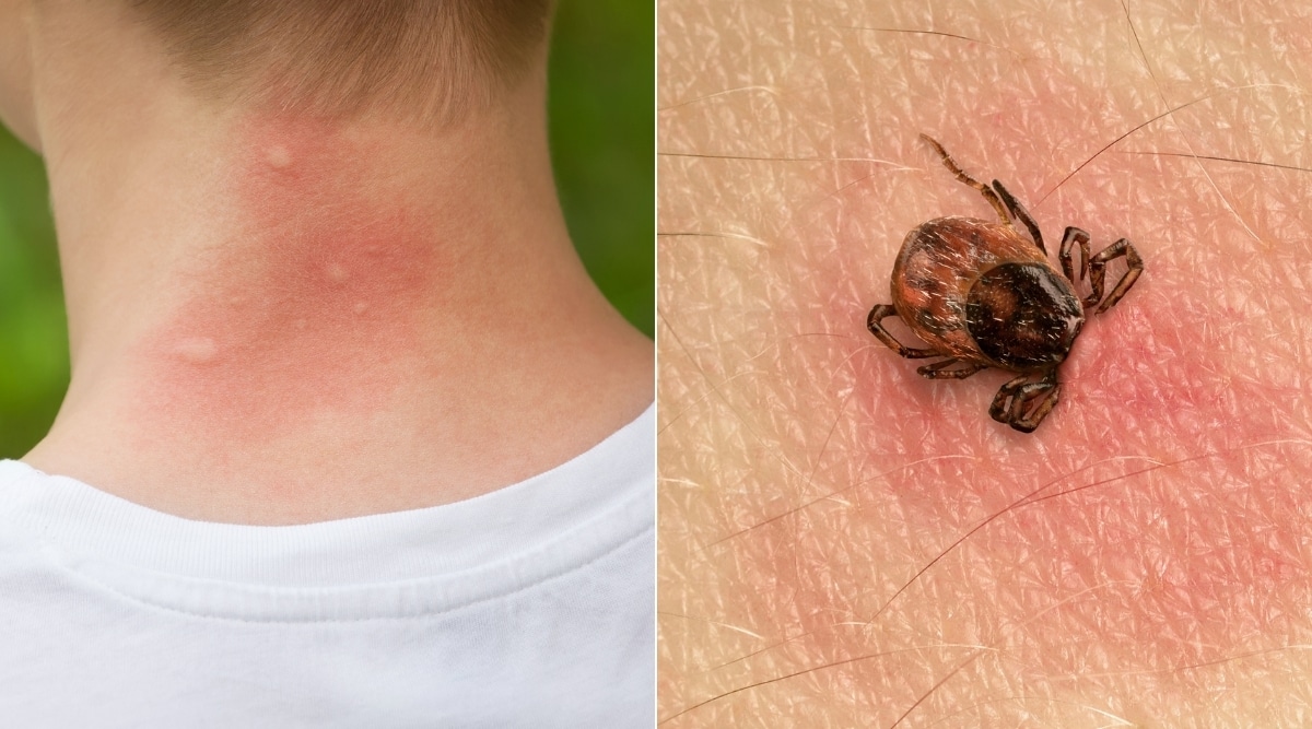Mosquito and Tick Bites