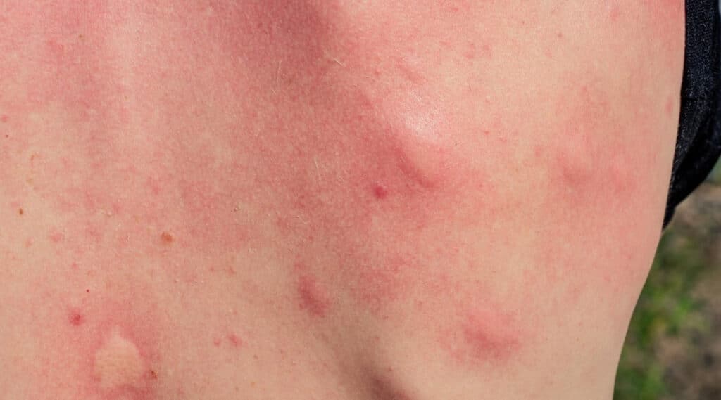 Mosquito Bite on Human Skin