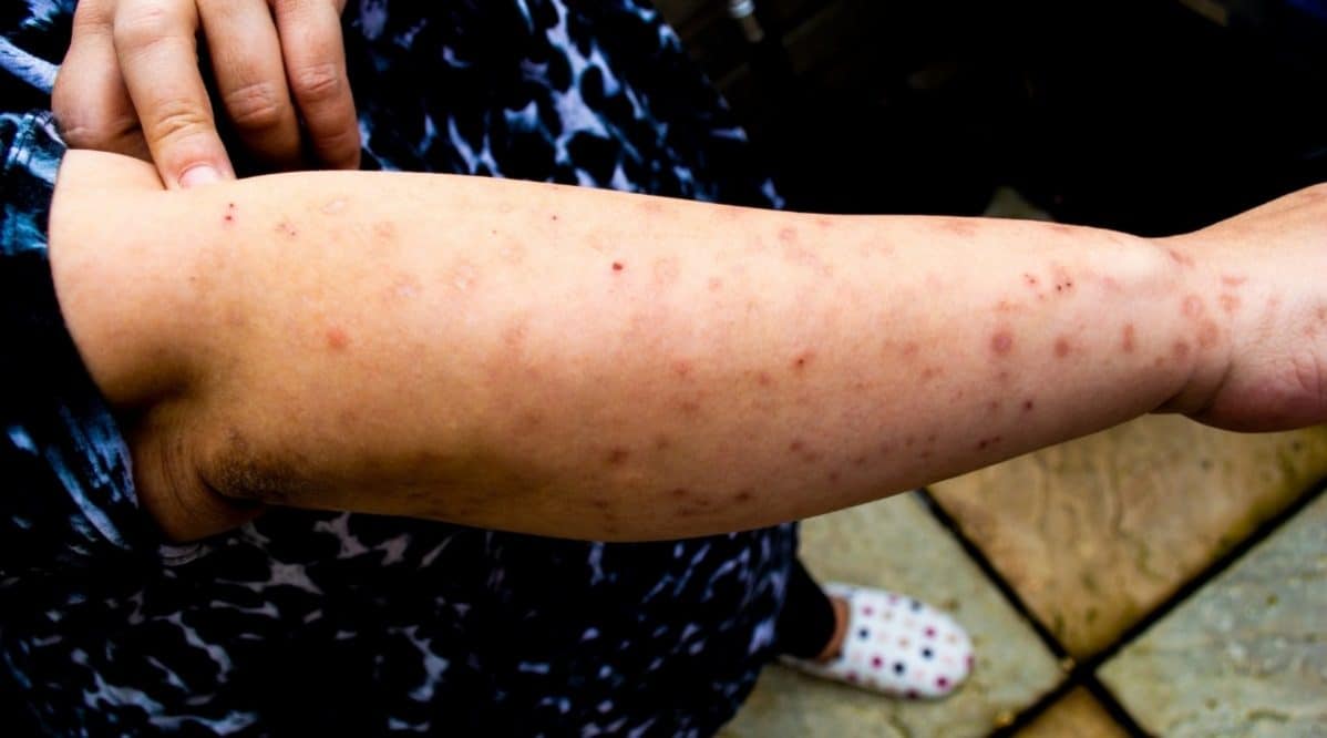 Bed Bugs vs. Scabies Bites: What's The Difference?