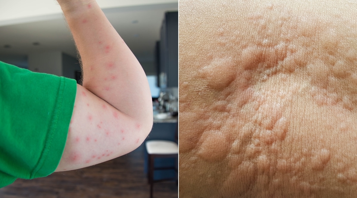 Bed Bug Bites and Urticaria