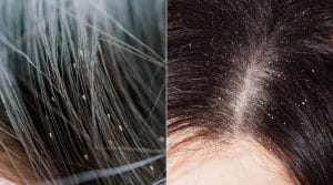 Head Lice vs. Dandruff: Identifying What You Have