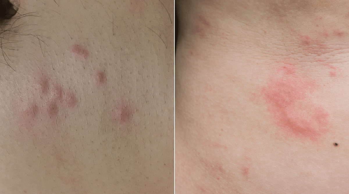 Raised Red bumps on Human Skin